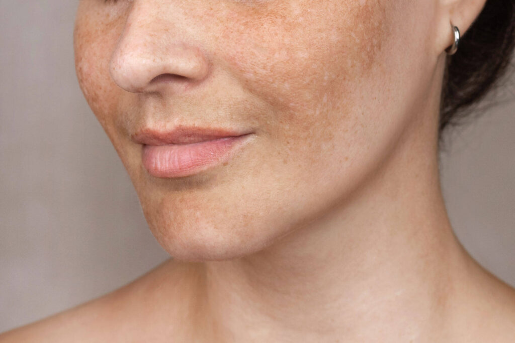 melasma1_1731417401